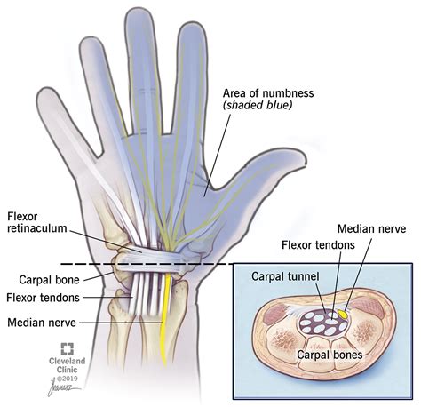 nerve damage and susceptibility to injury, such as carpal tunnel syndrome); . . 38 cfr carpal tunnel syndrome